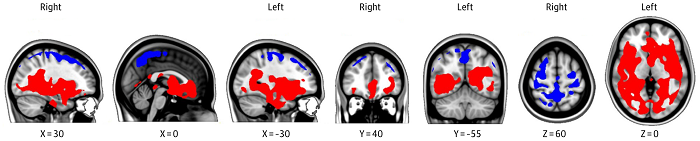 Preflight to post flight change in free water (FW) in astronauts&rsquo; brains. Source: University of Utah