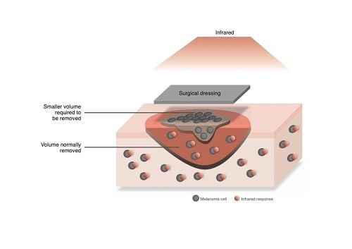 The photothermal therapy efficiency of surgical dressing would enable much smaller surgical resections compared to current procedures and eliminate residual melanoma cells. Source: University of Nottingham
