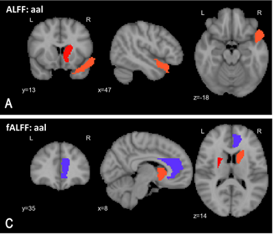 Some of the most reliable indicators the algorithm found are highlighted, where red indicates elevated activity and blue indicates suppressed activity in the brain. Source: Sunil Kalmady, University of Alberta