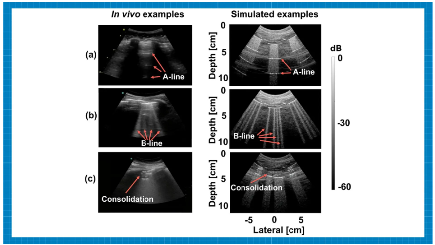 In vivo and simulated examples of (a) A-line, (b) B-line, and (c) consolidation features. Source: Lingyi Zhao et al.