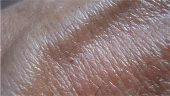 A new way to uncover skin cancer before it becomes visible