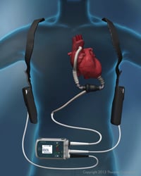 Thoratecs HeartMate II LVAD is implanted just below the diaphragm and attaches to the aorta. An external, wearable controller links to the implant via a driveline that passes through the skin. Image source: Thoratec