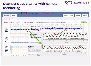 Doctors and other clinicians can remotely monitor pump performance for ReliantHearts LVADs.