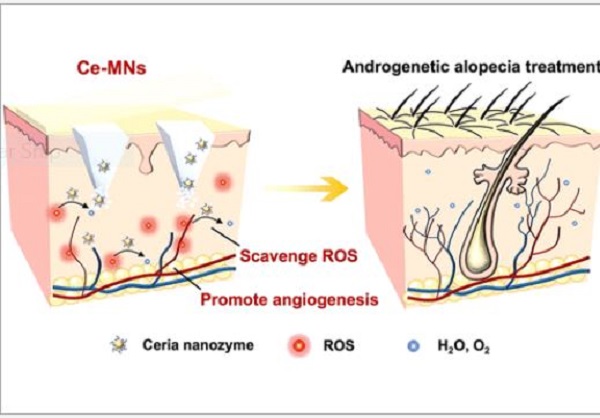 The patch tackles the oxidative stress and insufficient circulation conditions responsible for androgenic alopecia. Source: Jianqing Gao et al.
