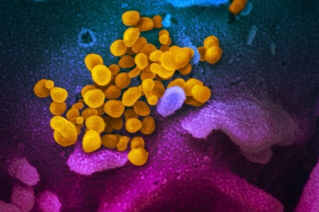 This scanning electron microscope image shows SARS-CoV-2 (yellow) — also known as 2019-nCoV, the virus that causes COVID-19 — isolated from a patient, emerging from the surface of cells (blue/pink) cultured in the lab. Source: NIAID-RML