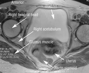 The same pelvis MRI image, but using a T2 wave. 