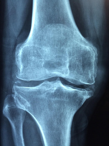 New drug-delivery cartilage material shows promise for arthritis ...