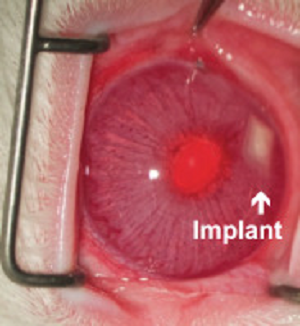 The biodegradable implant shown in the eye of a rabbit. Image credit: Jean Kim/Desai Lab