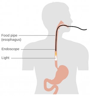 Camera Spots Esophageal Pre-Cancers Earlier | GlobalSpec