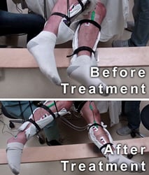 A man with complete motor paralysis moves his legs voluntarily while receiving electrical stimulation to his spinal cord via electrodes placed on his back. Image credit: Edgerton laboratory/UCLA