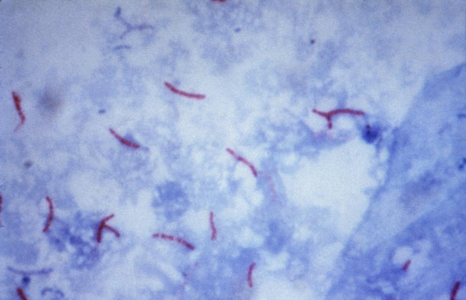 This photomicrograph reveals Mycobacterium tuberculosis bacteria using acid-fast Ziehl-Neelsen stain; Magnified 1000 X. The acid-fast stains depend on the ability of mycobacteria to retain dye when treated with mineral acid or an acid-alcohol solution such as the Ziehl-Neelsen, or the Kinyoun stains that are carbolfuchsin methods specific for M. tuberculosis.