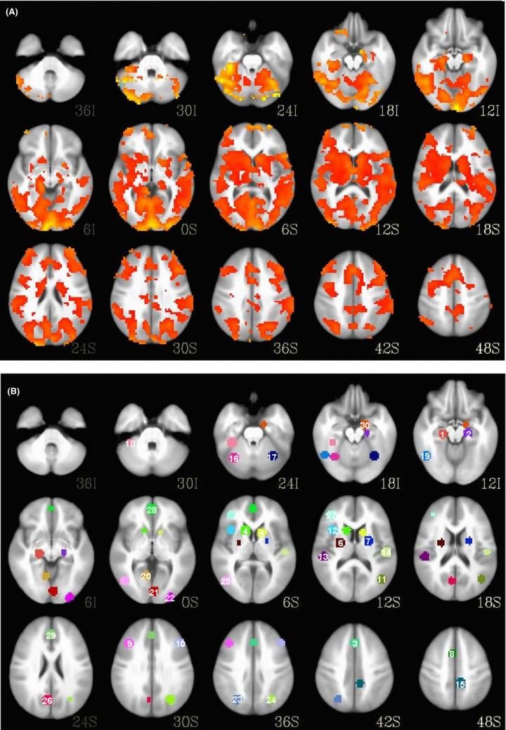 Comparison of MRI brain scans of a bipolar patient (top) and a healthy patient (bottom). (Credit: David Fleck/University of Cincinnati) 