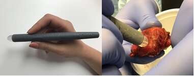 The MasSpec Pen (left) may help cancer surgeons determine the edges of tumors in the operating room; researchers used it to analyze thyroid tissue ex vivo (right) and are now testing it in vivo with human patients. Source: Eberlin lab/University of Texas at Austin