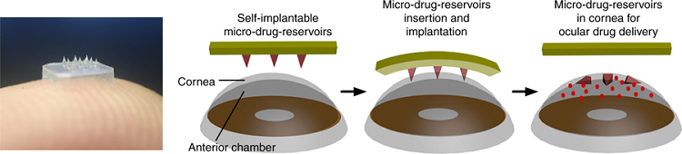The eye-contact patch for ocular drug delivery is equipped with an array of self-implantable micro-drug-reservoirs. Source: NTU Singapore