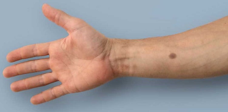 Artificial Mole Could Warn of Cancer