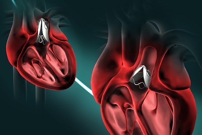 At left, the valve in its unexpanded state; at right, its expanded configuration in a larger heart. Source: Sophie Hofferberth, Boston Children’s Hospital; Lara Tomholt and James Weaver, Wyss Institute for Biologically Inspired Engineering