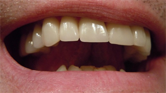 New dental treatment adopts high-tech coating to combat tooth decay