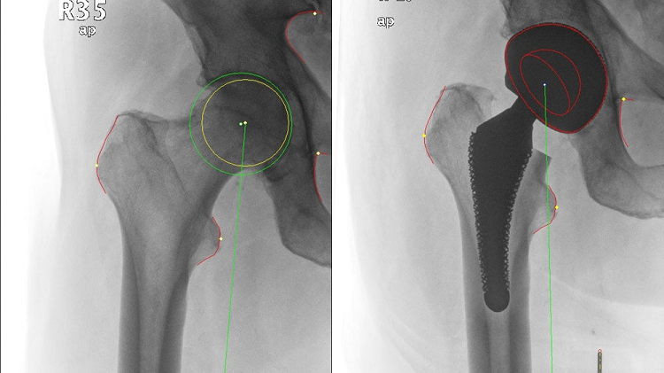Custom software advises the surgeon on what size implant to select and helps define its position. Source: Fraunhofer IWU