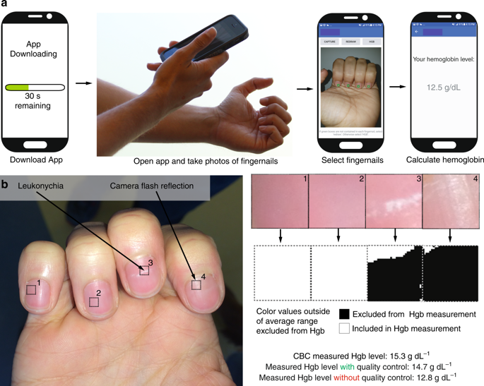 A patient downloads the app onto their smartphone, opens the app, obtains a smartphone photo of his/her fingernail beds, and without the need for any blood sampling or additional smartphone attachments quantitatively measures blood hemoglobin levels. Source: Mannino et al Nature Communications 2018
