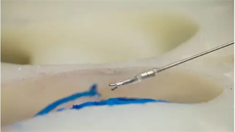 Magnet-powered miniature robots enable scalpel-free brain surgery