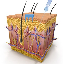Tiny microneedles sip fluid in the middle layer of skin between the layer of dead skin cells and above where veins and nerves reside. The devices are far less painful than traditional hypodermic needles. (Credit: U.S. Sandia National Laboratories)