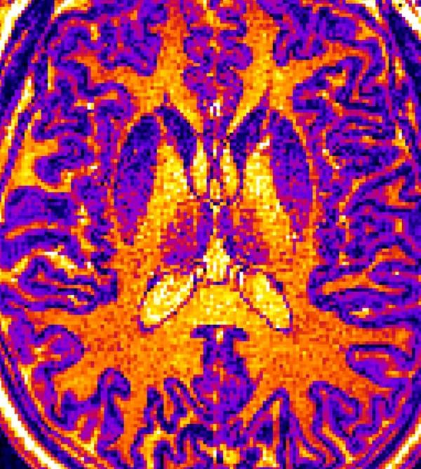 MRI images like this one were screened by a machine learning computer algorithm designed by a research team at the University of Tokyo. Source: Shinsuke Koike, CC-BY 3.0