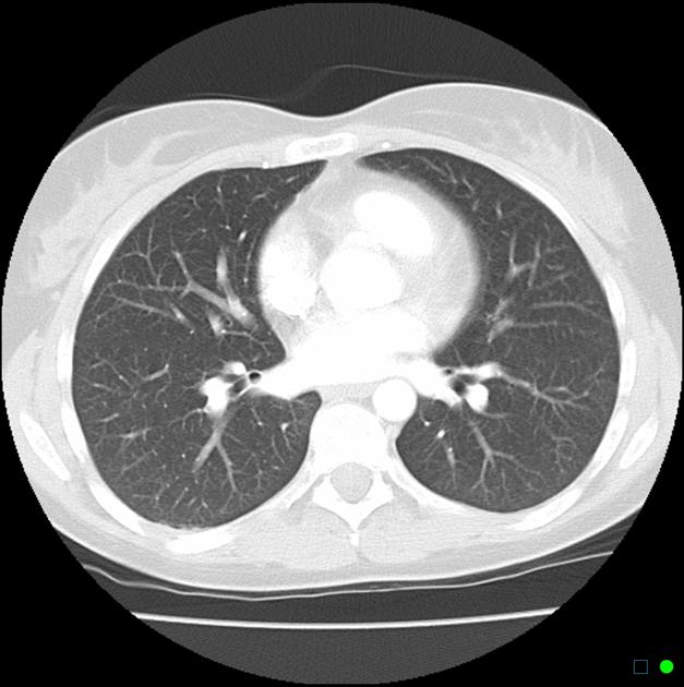 How CT technology assists in the fight against COVID-19 | GlobalSpec