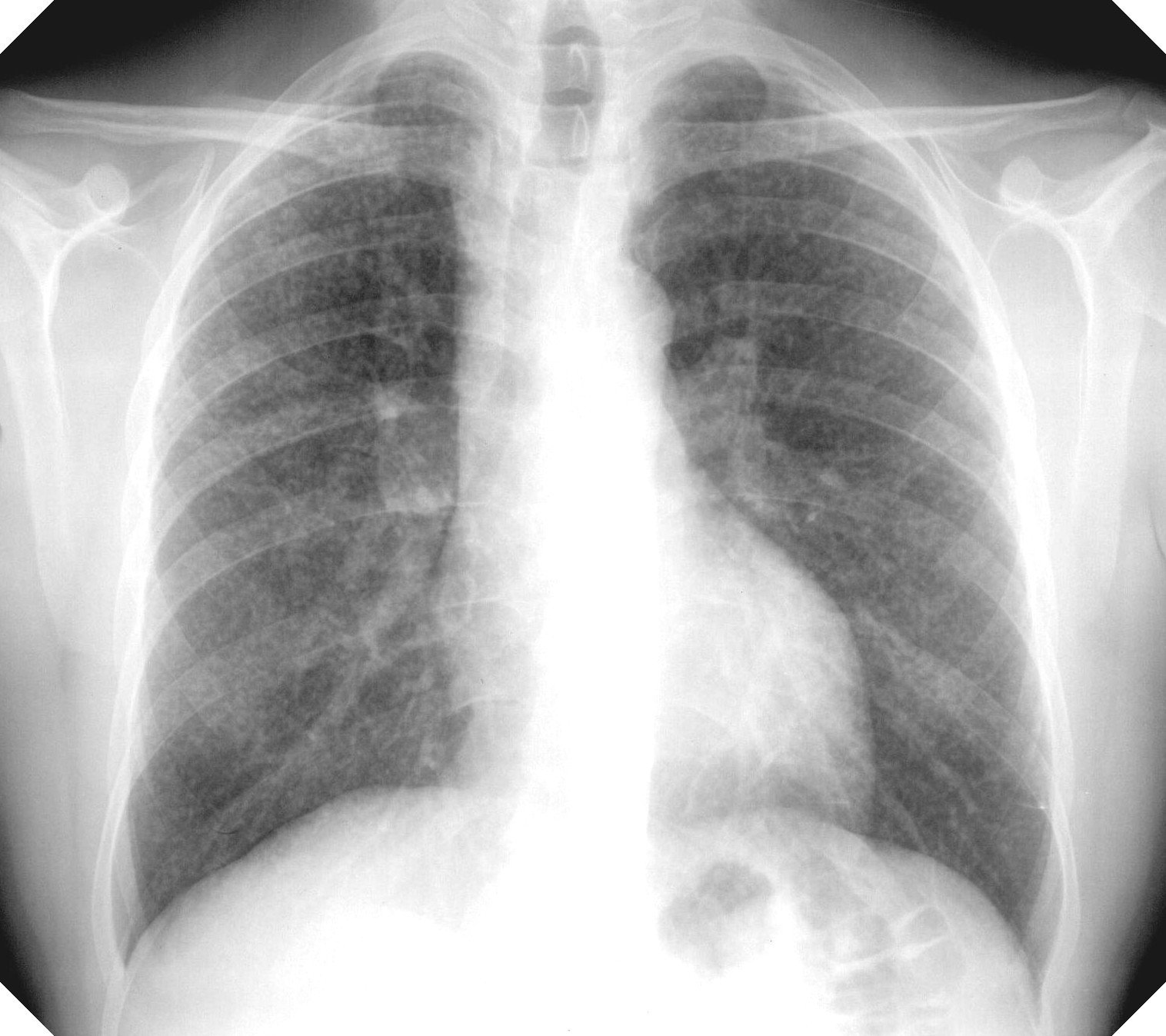 X-ray of silicosis in the lungs