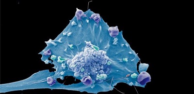  Breast cancer cell. Source: Anne Weston, Francis Crick Institute