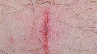 Smart wound zipper conforms to irregular skin injuries, boosts healing in rats