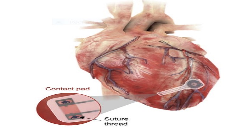 Watch a battery-free pacemaker vanish
