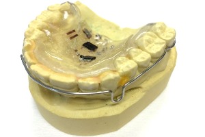 Sensors are mounted on an orthodontic retainer worn inside the mouth. Image credit: VCU.