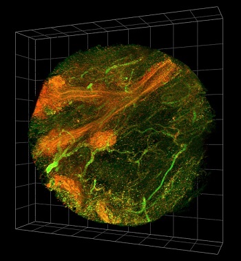 The cell nuclei are pictured here in red and the background structures and fibers are green in a 3D breast cancer biopsy.  Source: University of Newcastle